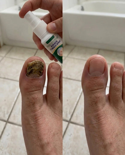 FungiClear™ – Spray Antihongos para Uñas y Pies