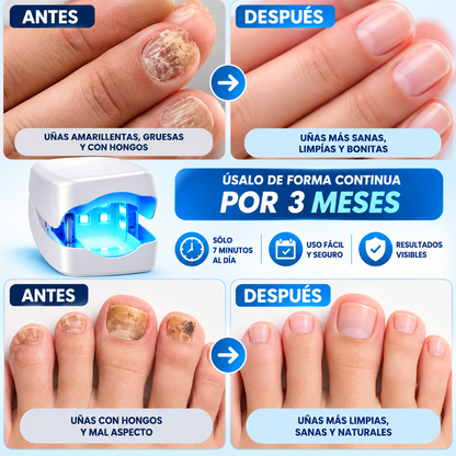 NailLight Pro™ – Láser Antihongo Para Uñas